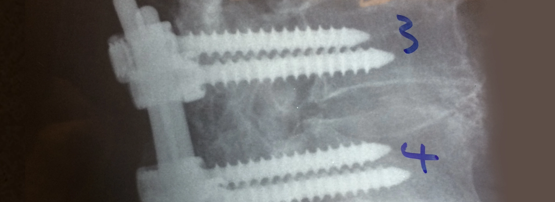 Lumbar Fusion Banner Image
