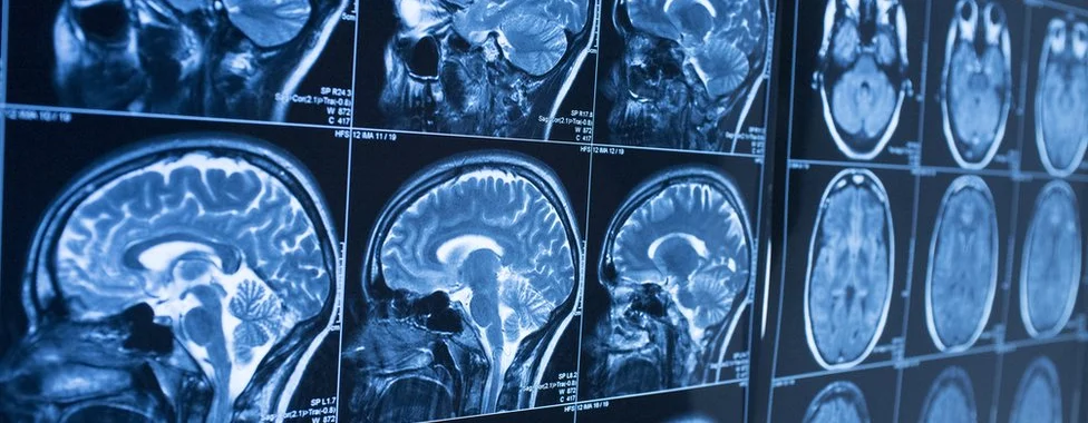 MRI  Scans Banner Image