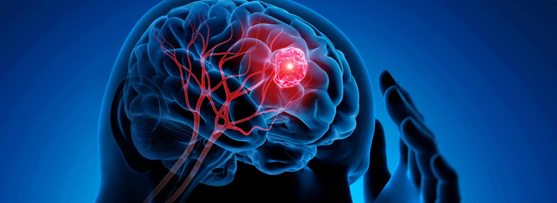 Brain Tumor Banner Image