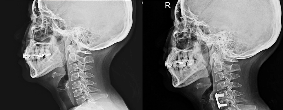 Cervical Fusion Banner Image