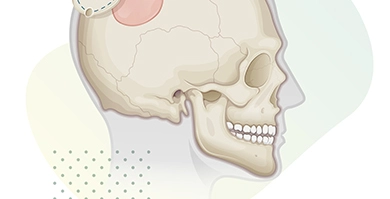 Craniotomy Thumbnail