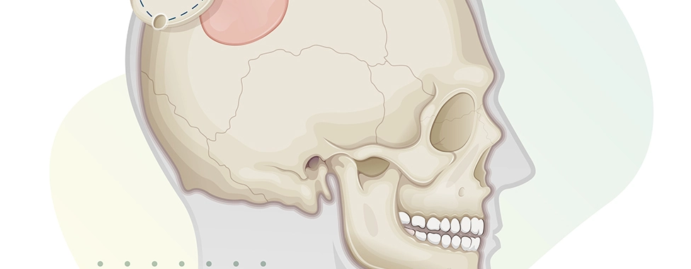 Craniotomy Banner Image