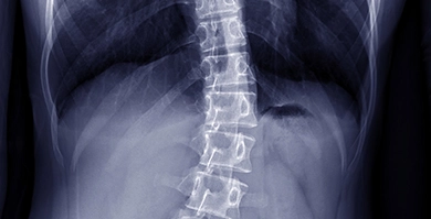 Scoliosis Thumbnail