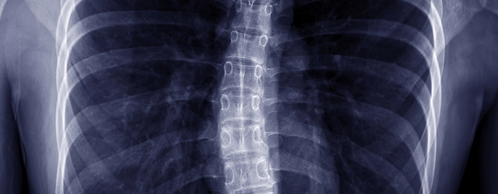 Scoliosis Banner Image
